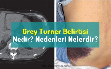 Grey Turner belirtisi nedir? Nedenleri nelerdir?