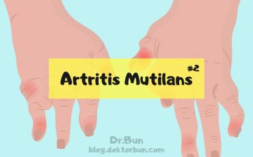 Artritis Mutilans: Nedir? Nedenleri Nelerdir? 1 Artritis mutilans nedir? Teleskopik parmak nedir?